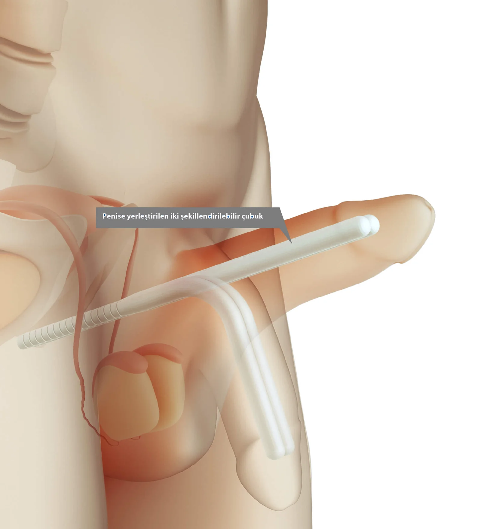 Implant pénien semi-rigide (prothèse pénienne malléable), dispositif de marque premium