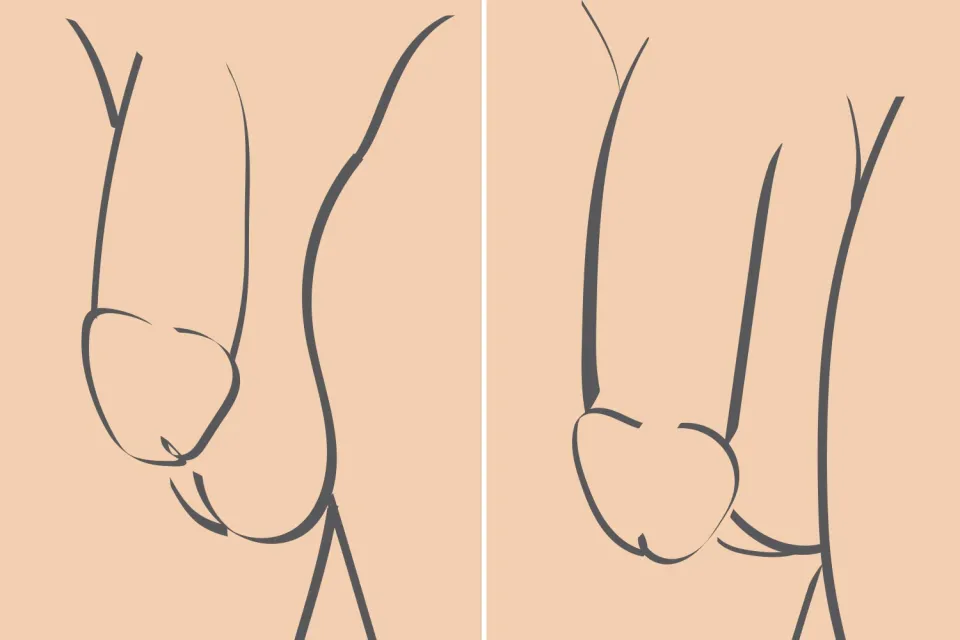 chirurgie agrandissement pénis